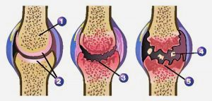 bolecine v kolenu pri pocepu, vzrok artroza