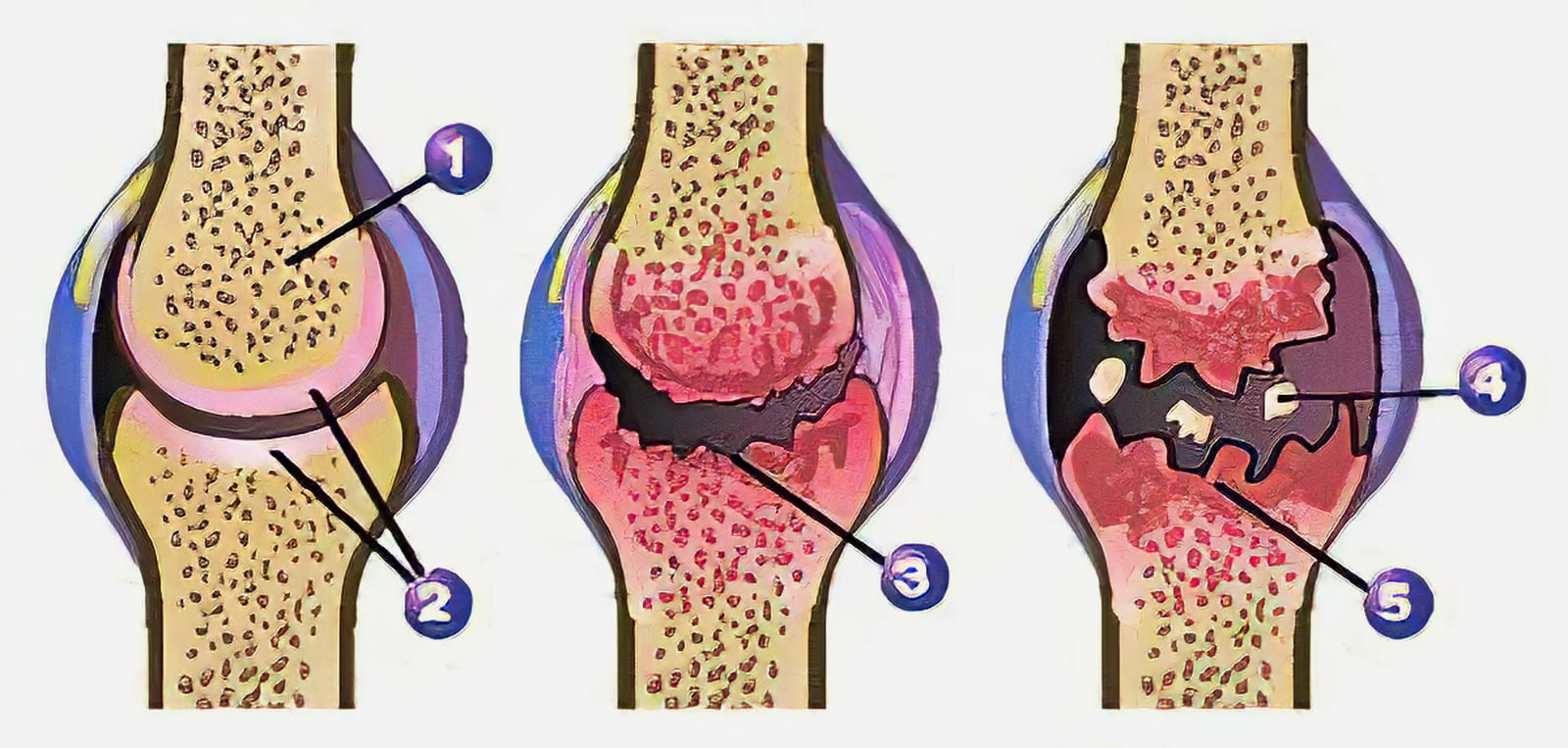artroza kolena forum